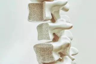Osteoporosis, la enfermedad ósea más frecuente entre la población